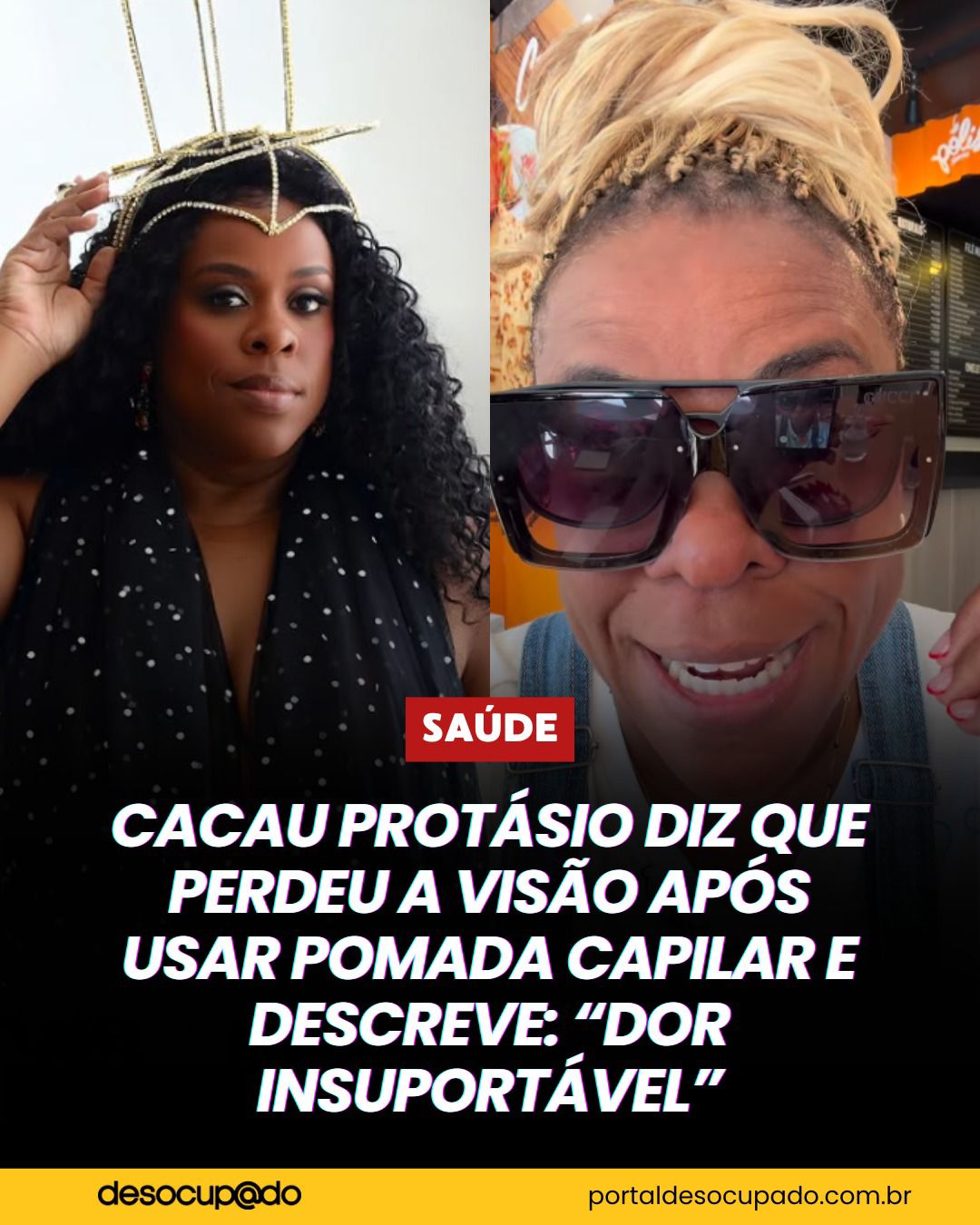 Cacau Protásio relata perda de visão após reação a pomada capilar