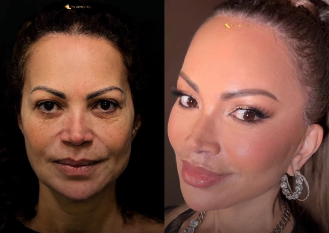 Solange Almeida exibe transformação no rosto e viraliza entre famosos