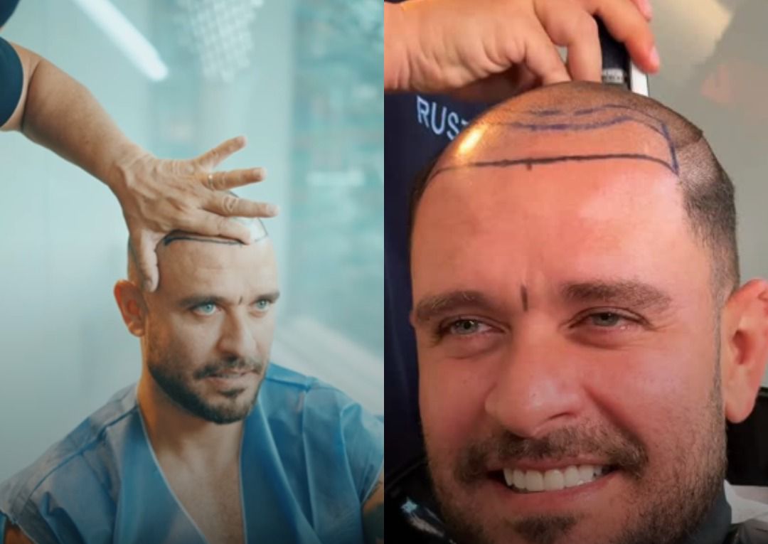 Diogo Nogueira passa por novo transplante capilar e mostra mudança no visual