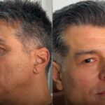 Aos 62 anos, Maurício Mattar faz harmonização facial e resultado surpreende