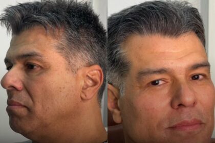 Aos 62 anos, Maurício Mattar faz harmonização facial e resultado surpreende