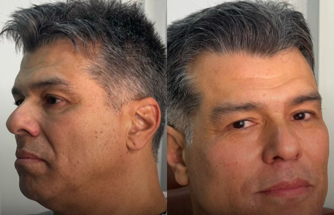 Aos 62 anos, Maurício Mattar faz harmonização facial e resultado surpreende