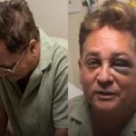 SUSTO! Cantor Leonardo sofre acidente e aparece com olhos roxos.