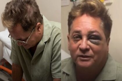 SUSTO! Cantor Leonardo sofre acidente e aparece com olhos roxos.
