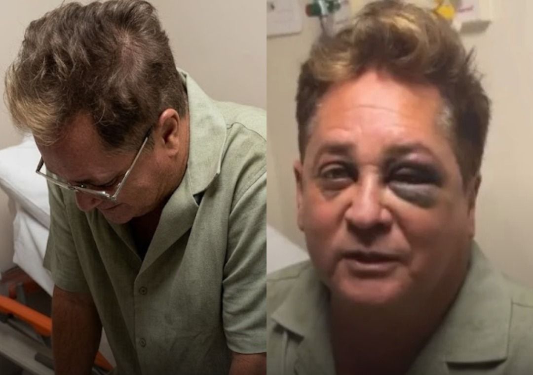 SUSTO! Cantor Leonardo sofre acidente e aparece com olhos roxos.